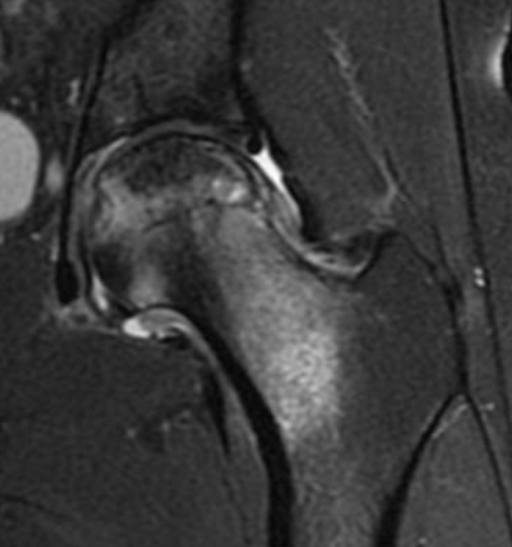 Osteonecrose da Cabeça Femoral