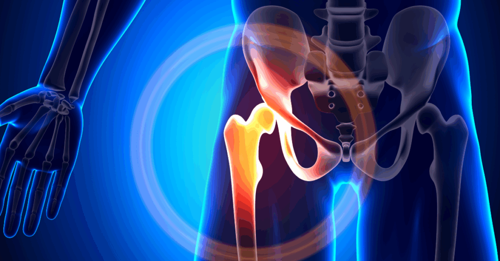 Os Avanços Tecnológicos em Artroplastia do Quadril 1 Os Avanços Tecnológicos em Artroplastia do Quadril