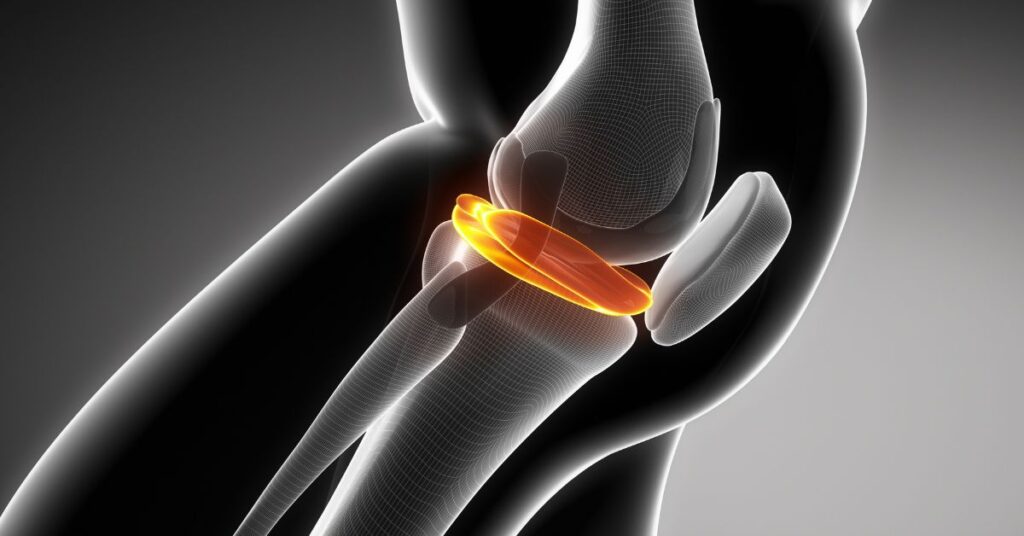 Comparação: Tratamentos para Ruptura do Menisco Lateral com e sem cirurgia 1 2 1 Comparacao Tratamentos para Ruptura do Menisco Lateral com e sem Cirurgia